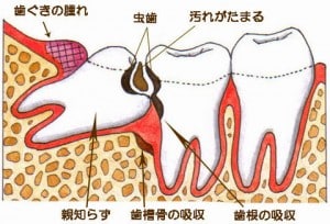 親知らず画像ｊ